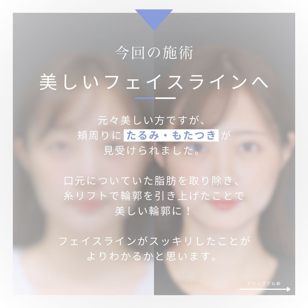 TAC式 ツヤ肌コラーゲンリフト®/ジョールファット除去/顎のヒアルロン酸注射の症例写真 施術前後 