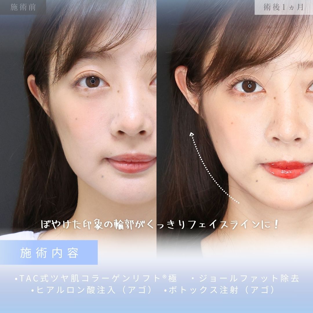 TAC式 ツヤ肌コラーゲンリフト®/ジョールファット除去/顎のヒアルロン酸注射の症例写真 施術前後 
