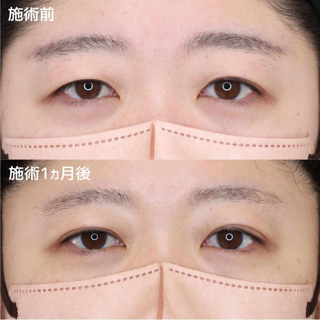 二重埋没法の症例写真 施術前後