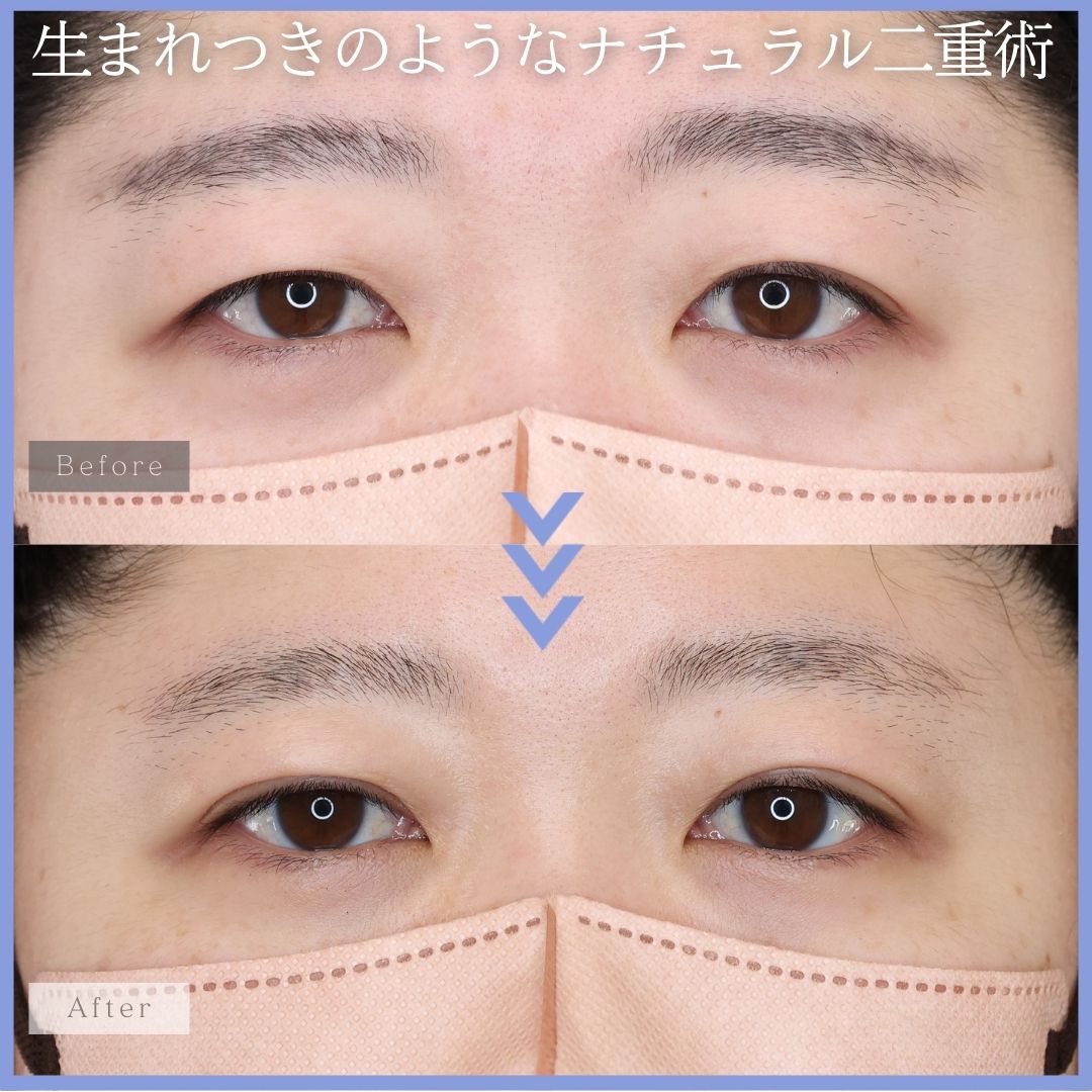 二重埋没法の症例写真 施術前後
