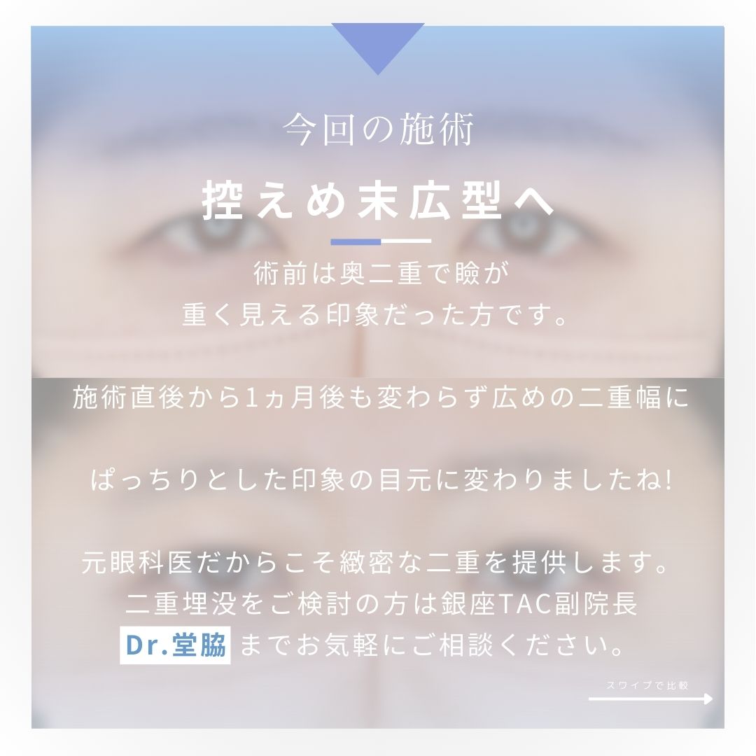 二重埋没法の症例写真 施術前後