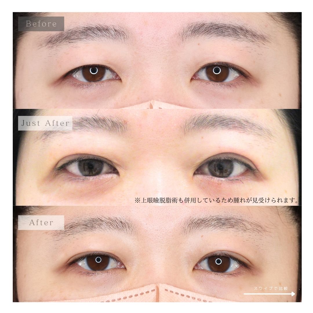 二重埋没法の症例写真 施術前後