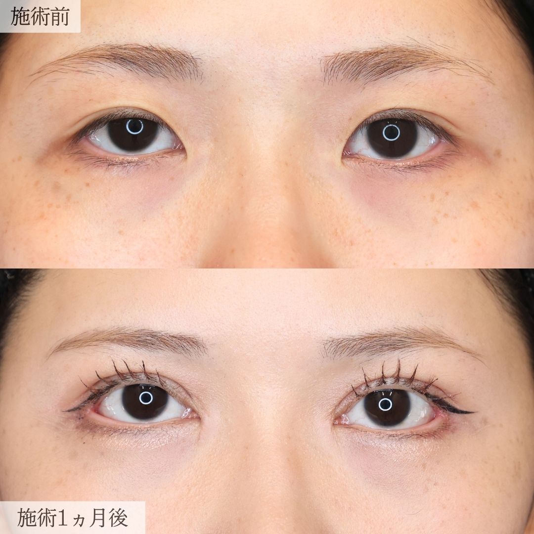 《目元フル整形》形成外科専門医による目元複合施術で別人級お目元に
