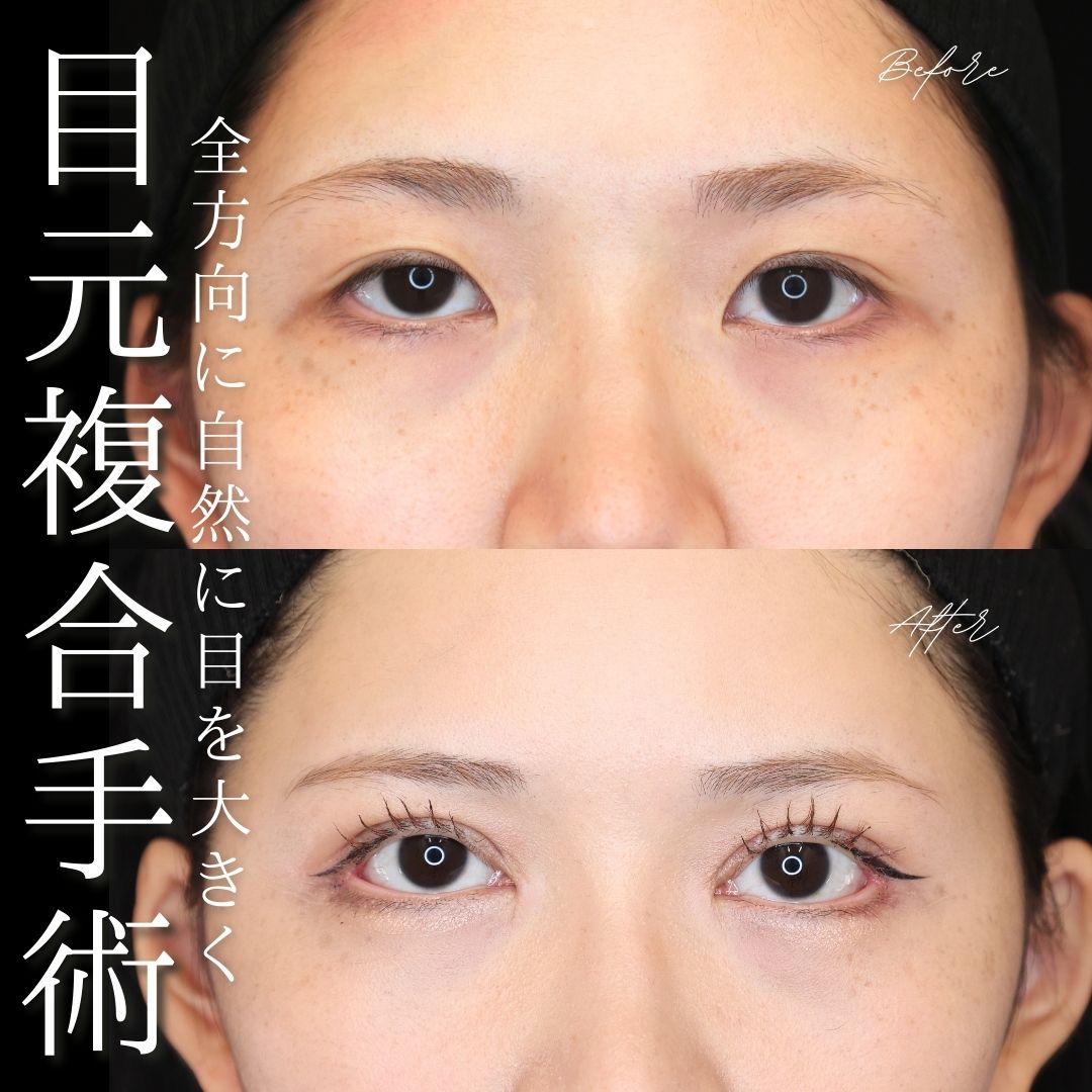 眼瞼下垂（目つき矯正）/二重切開（全切開法）/上眼瞼切開術の症例写真 施術前後 