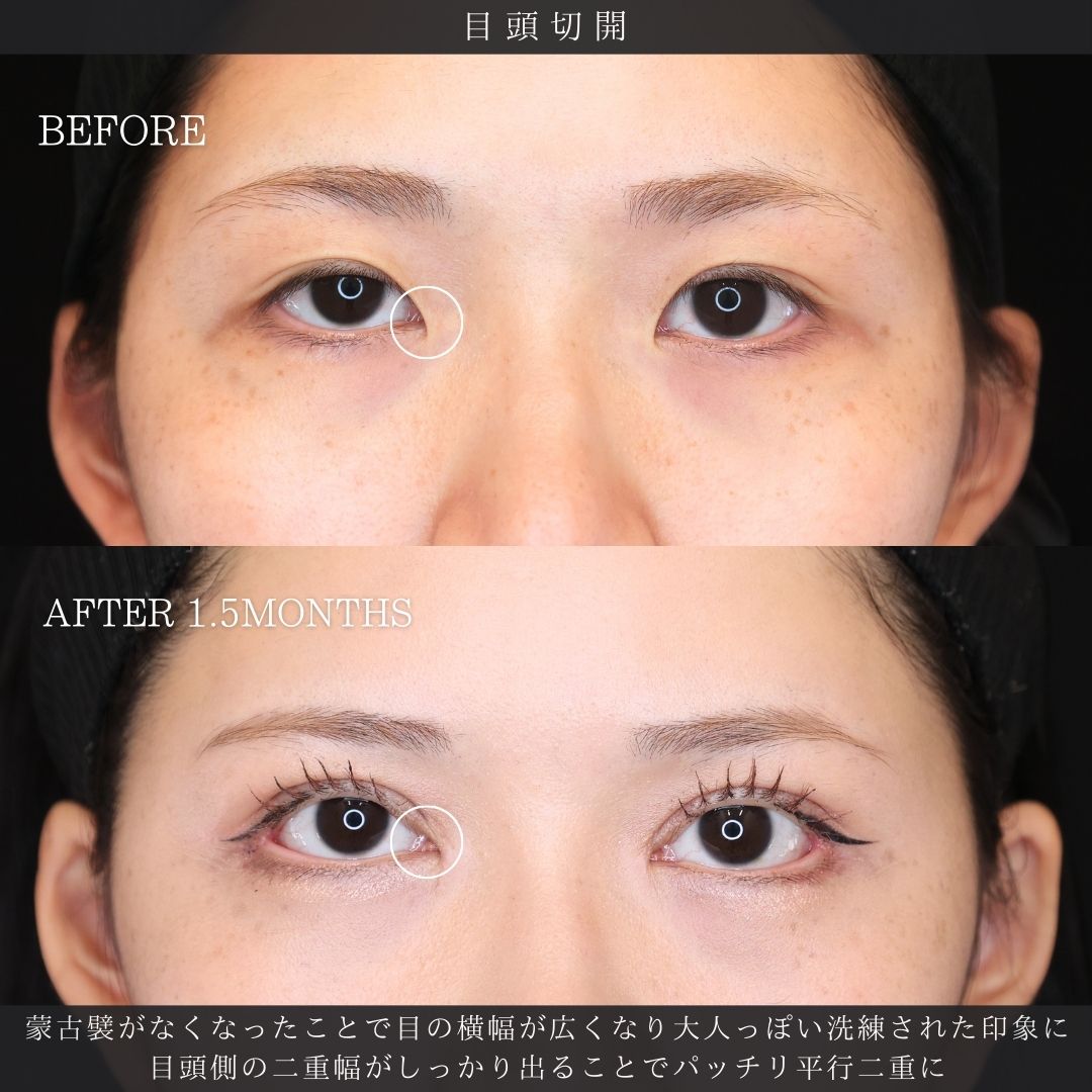 眼瞼下垂（目つき矯正）/二重切開（全切開法）/上眼瞼切開術の症例写真 施術前後 