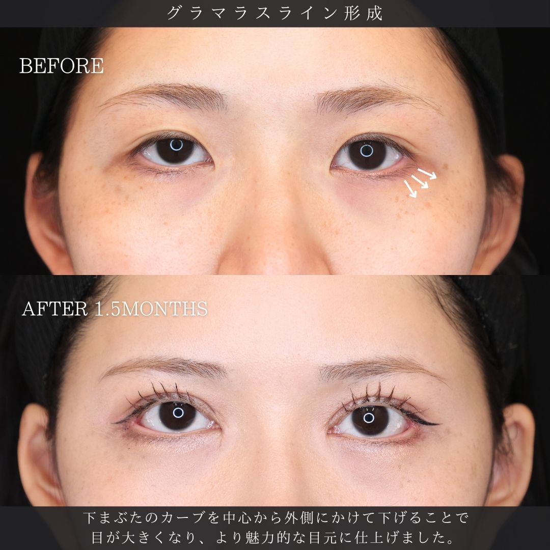 眼瞼下垂（目つき矯正）/二重切開（全切開法）/上眼瞼切開術の症例写真 施術前後 