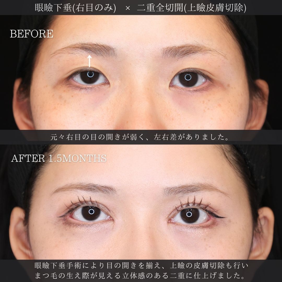 眼瞼下垂（目つき矯正）/二重切開（全切開法）/上眼瞼切開術の症例写真 施術前後 