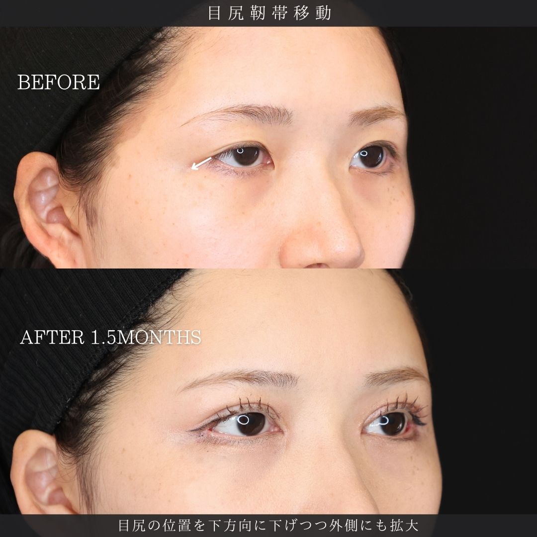 眼瞼下垂（目つき矯正）/二重切開（全切開法）/上眼瞼切開術の症例写真 施術前後 