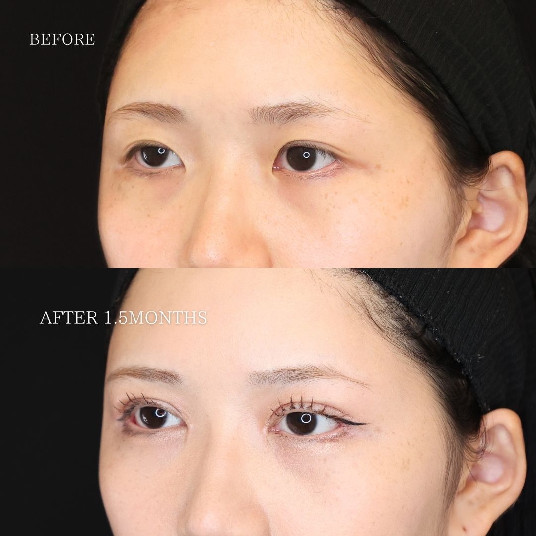 眼瞼下垂（目つき矯正）/二重切開（全切開法）/上眼瞼切開術の症例写真 施術前後 