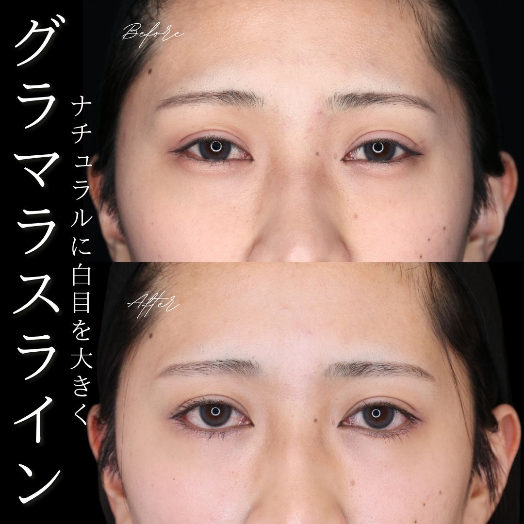 グラマラスライン（タレ目形成）の症例写真 施術前後 