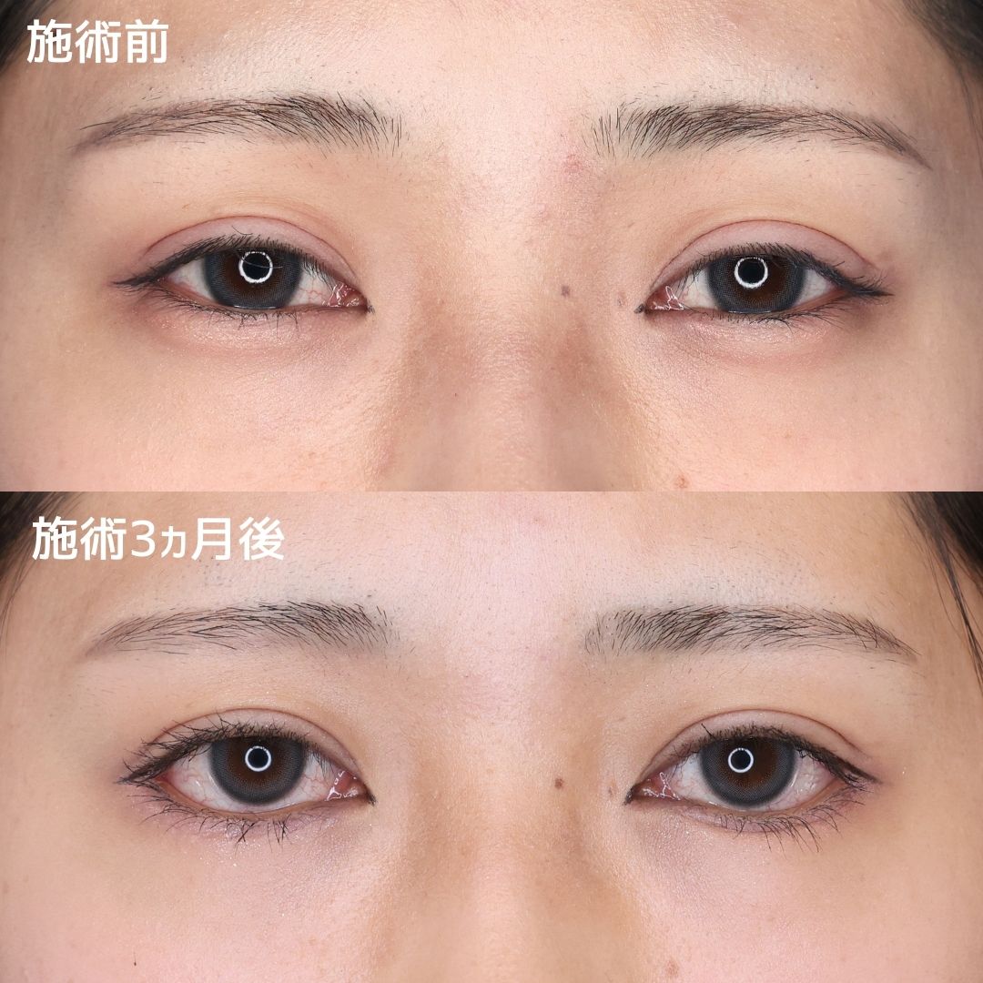 グラマラスライン（タレ目形成）の症例写真 施術前後 