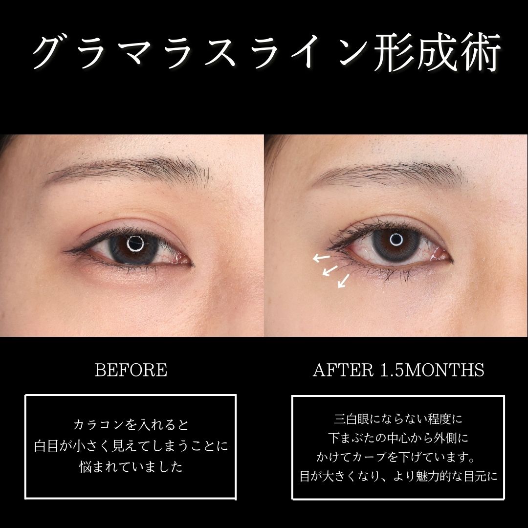 グラマラスライン（タレ目形成）の症例写真 施術前後 