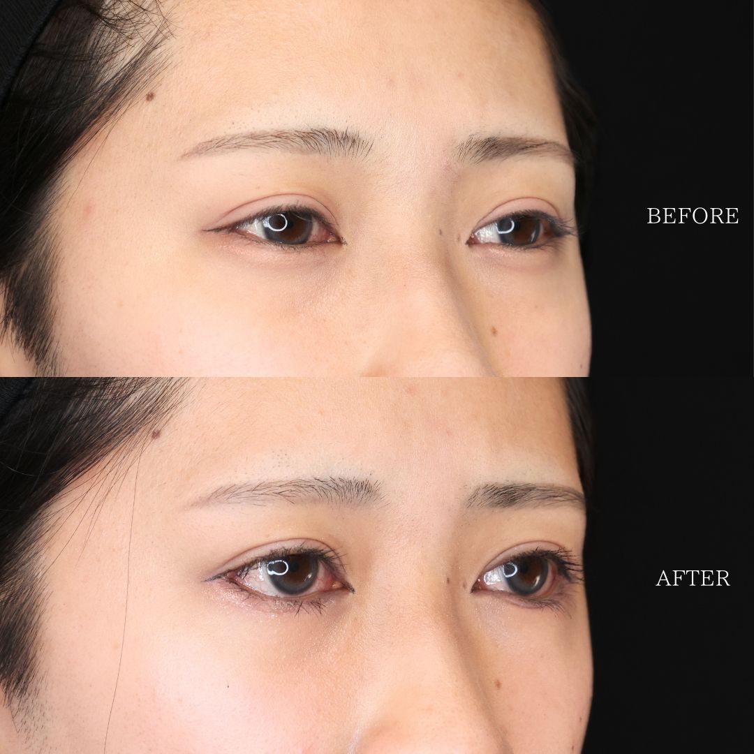 グラマラスライン（タレ目形成）の症例写真 施術前後 