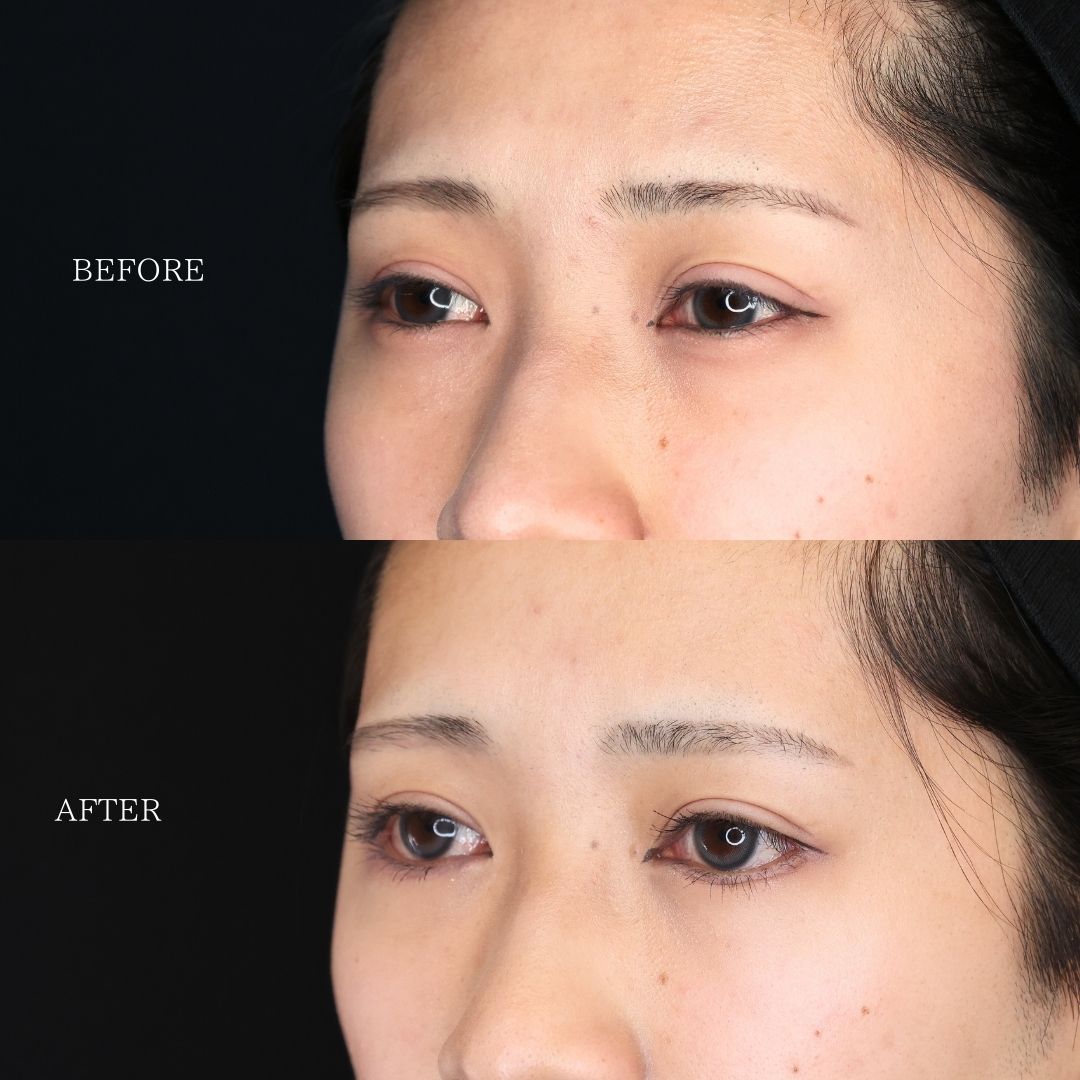 グラマラスライン（タレ目形成）の症例写真 施術前後 