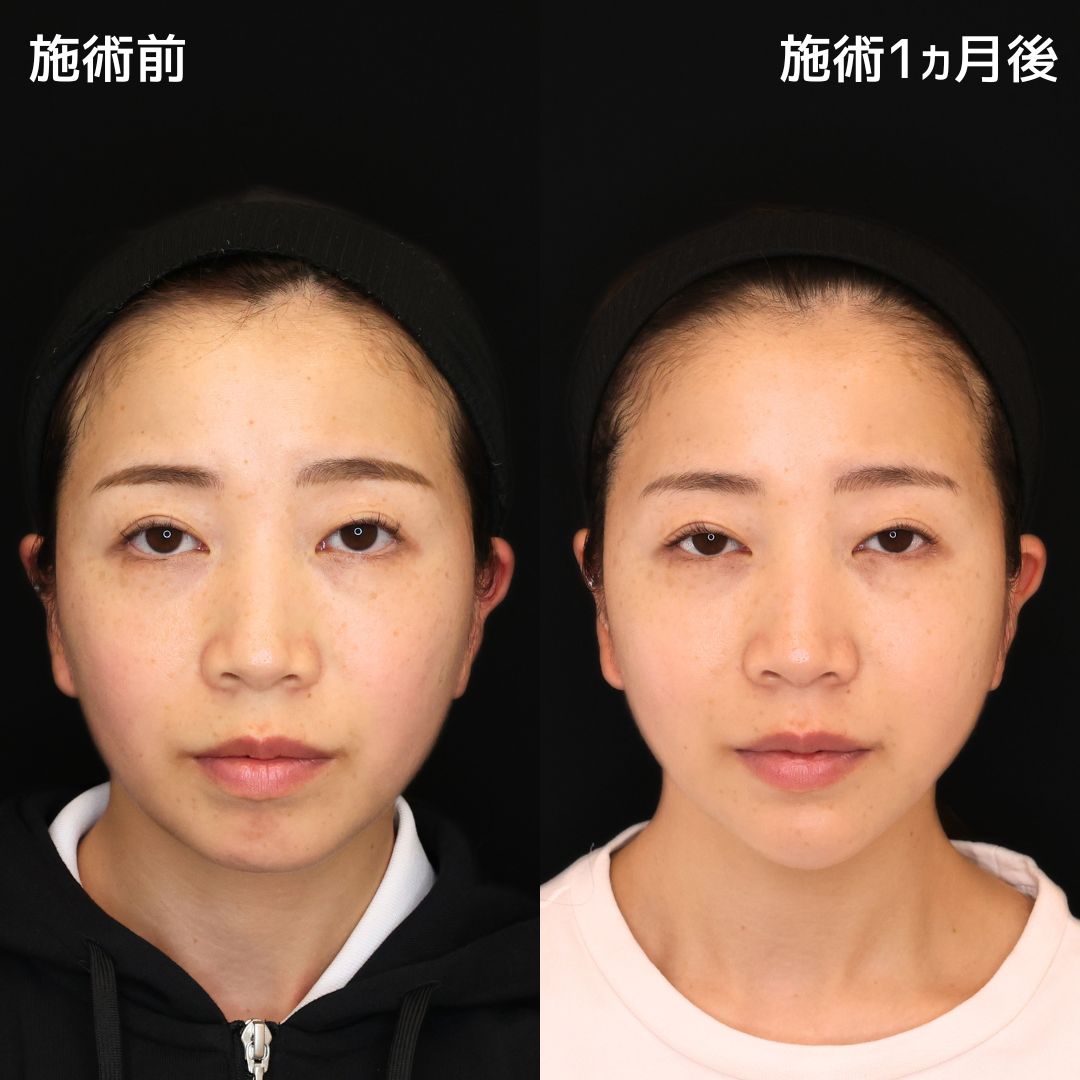 《小顔施術》年齢によるお顔のたるみは糸リフトで解決
