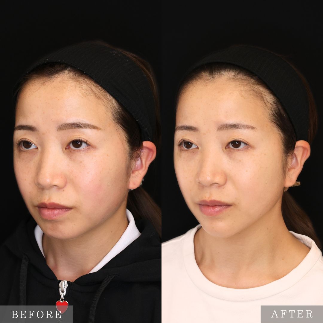 顎のヒアルロン酸注射/TAC式 ツヤ肌コラーゲンリフト®/エラボトックス注射の症例写真 施術前後 