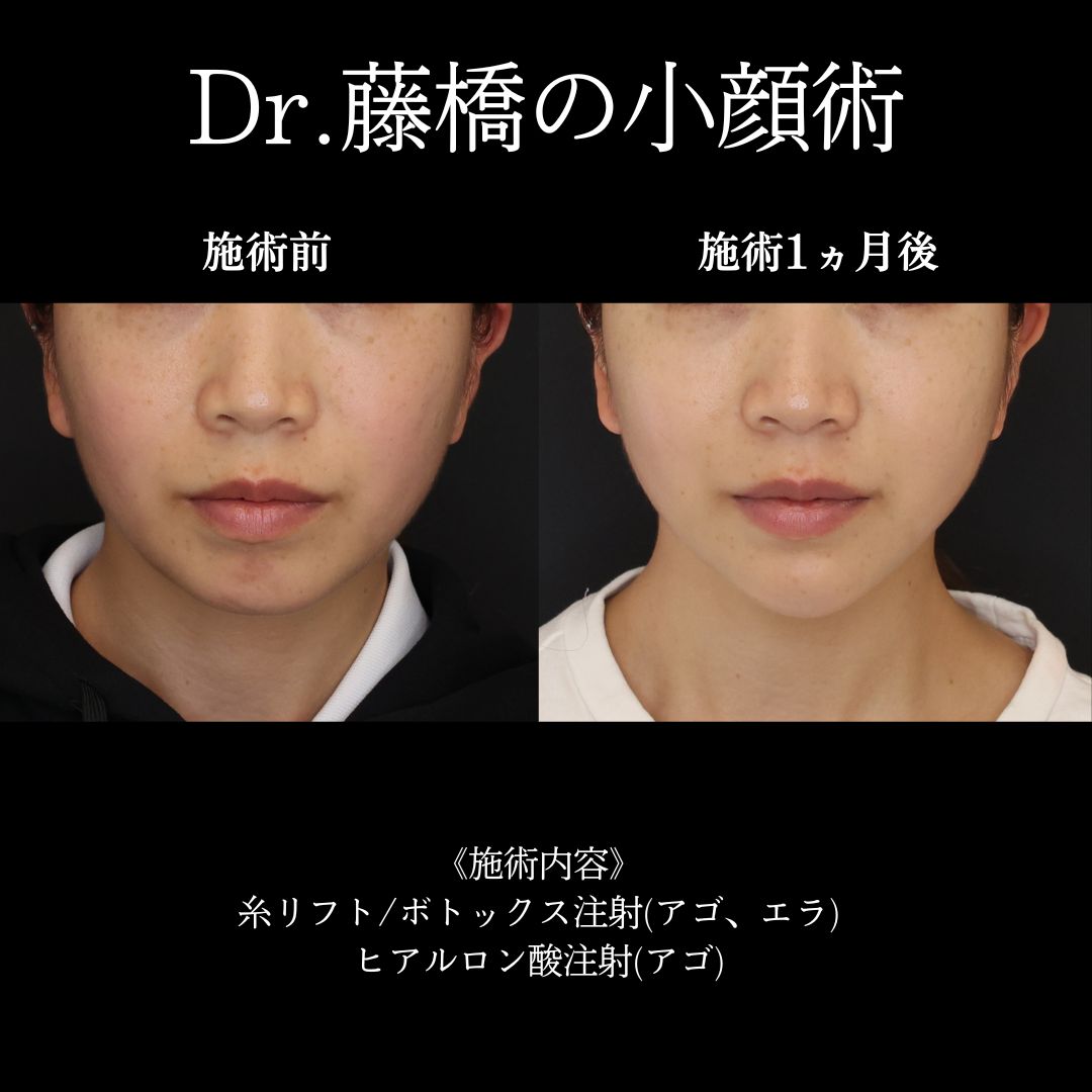 顎のヒアルロン酸注射/TAC式 ツヤ肌コラーゲンリフト®/エラボトックス注射の症例写真 施術前後 