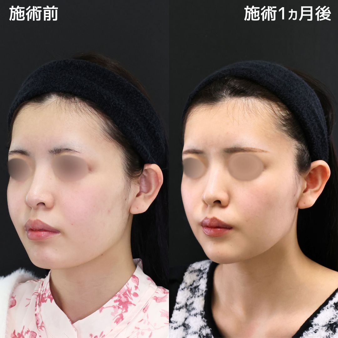《小顔整形》余分な脂肪は除去してスッキリ可愛く