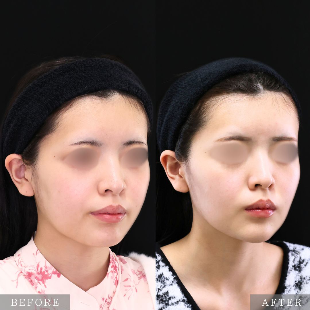 ジョールファット除去/Lラインファット除去（エラ下脂肪除去）/バッカルファット除去の症例写真 施術前後 