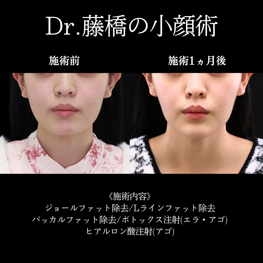 ジョールファット除去/Lラインファット除去（エラ下脂肪除去）/バッカルファット除去の症例写真 施術前後 