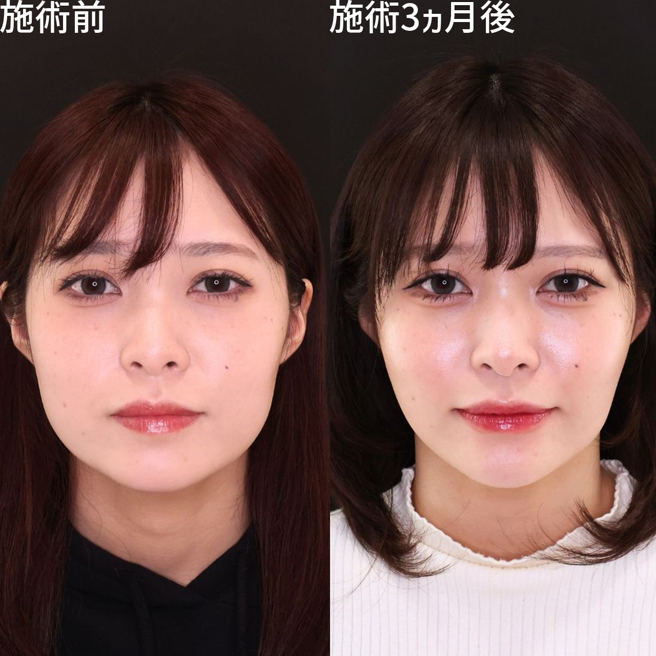 頬と口横のお肉を撃退！理想の輪郭でさらに可愛く