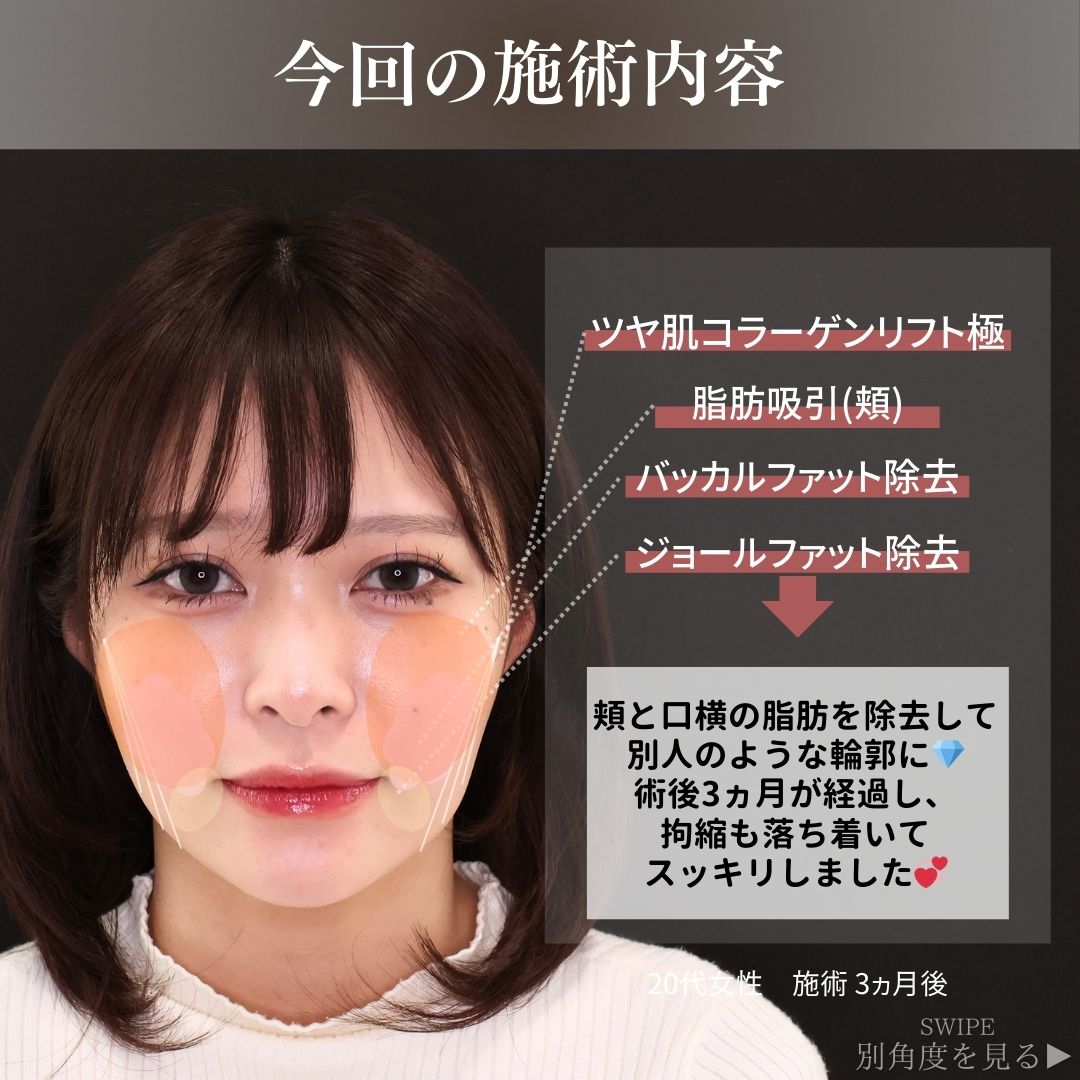 TAC式 ツヤ肌コラーゲンリフト®/顎下の脂肪吸引/バッカルファット除去の症例写真 施術前後 