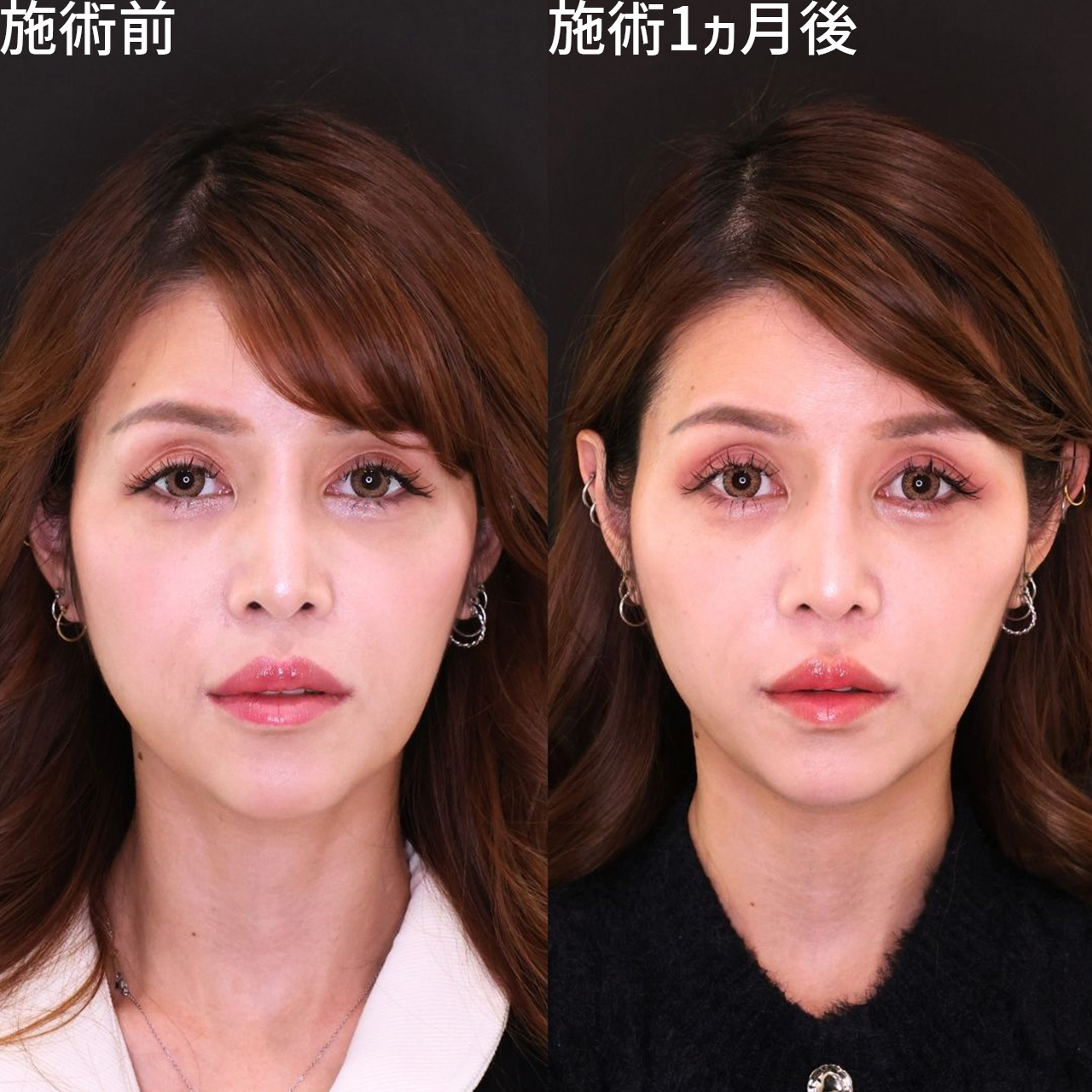 たるみの左右差と法令線を改善！女優級小顔術