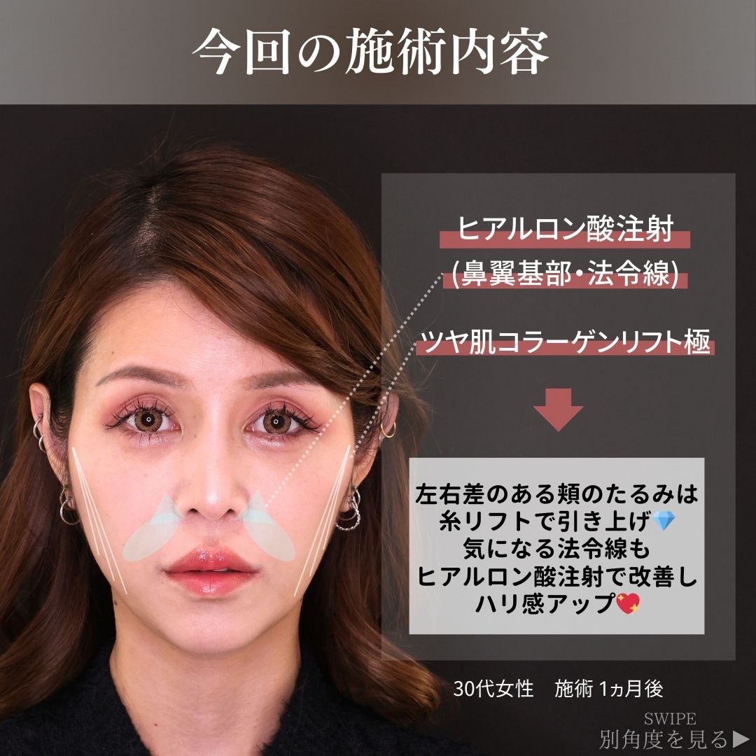 TAC式 ツヤ肌コラーゲンリフト®/ほうれい線のヒアルロン酸注射の症例写真 施術前後 