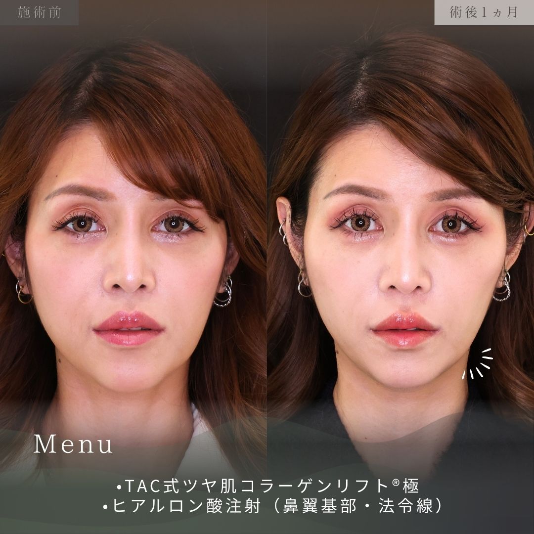 TAC式 ツヤ肌コラーゲンリフト®/ほうれい線のヒアルロン酸注射の症例写真 施術前後 