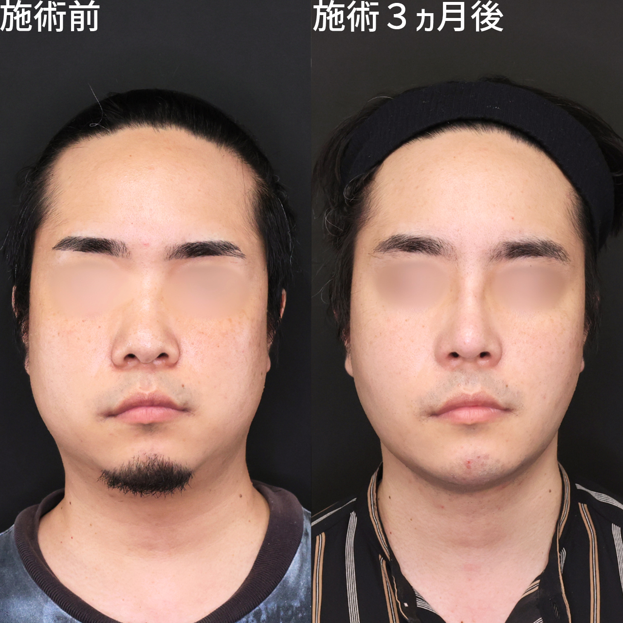 【脂肪除去×糸リフト】下膨れ感を解消！メンズ小顔術