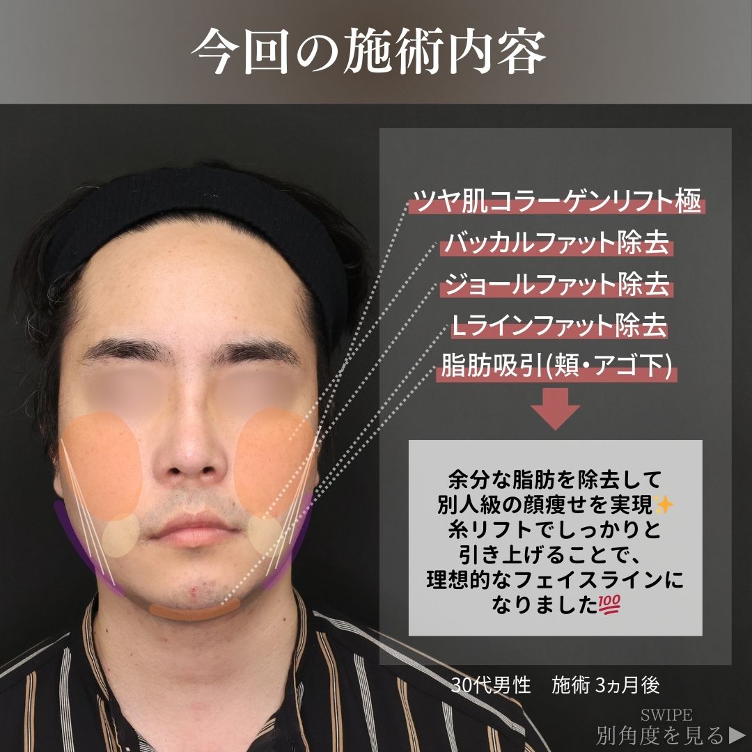 TAC式 ツヤ肌コラーゲンリフト®/顔の脂肪吸引/バッカルファット除去の症例写真 施術前後 