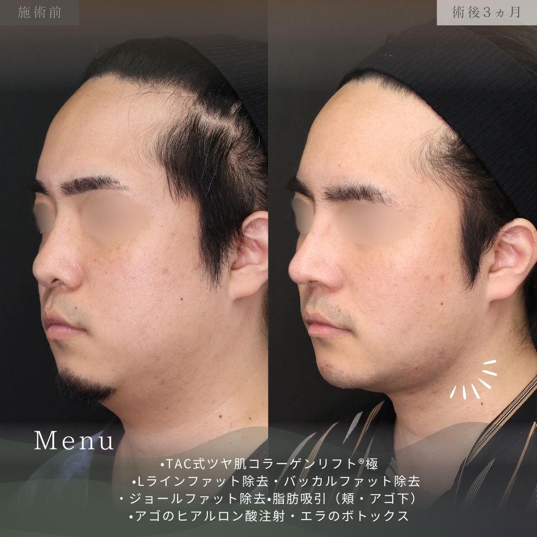 TAC式 ツヤ肌コラーゲンリフト®/顔の脂肪吸引/バッカルファット除去の症例写真 施術前後 