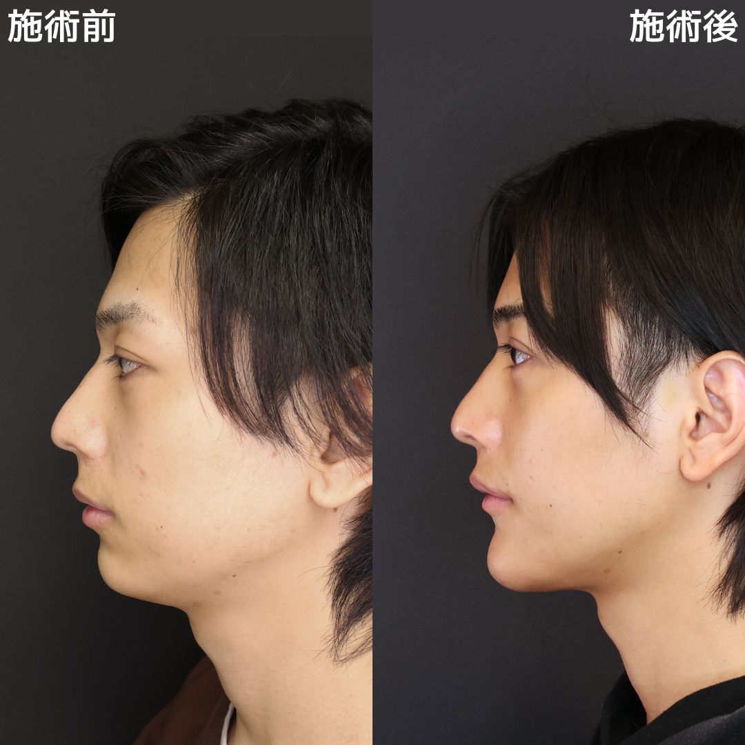《メンズ美容》ペリカン手術でアゴ下のたるみゼロに!