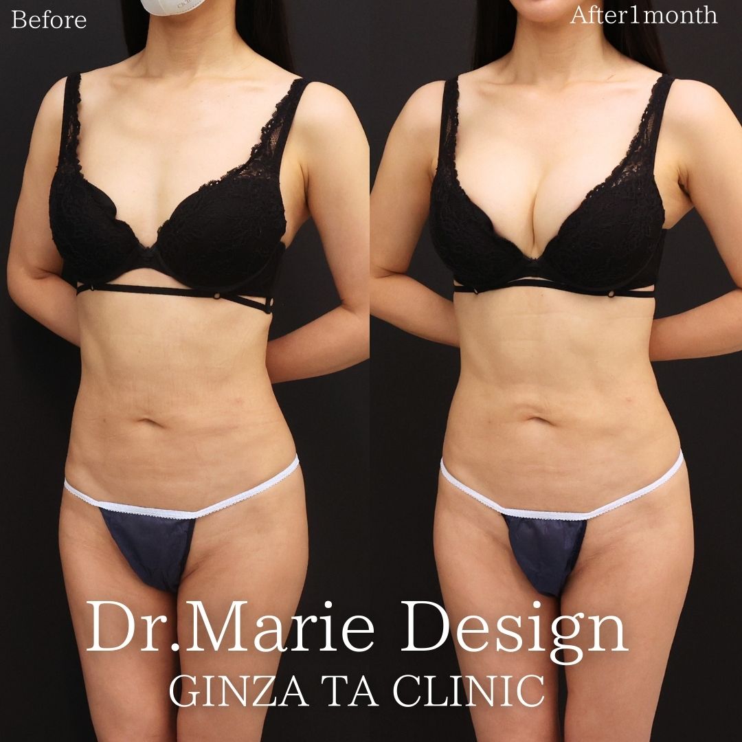 ボトックス注射：その他/シリコンバッグ豊胸（人工乳腺バッグ）の症例写真 施術前後 