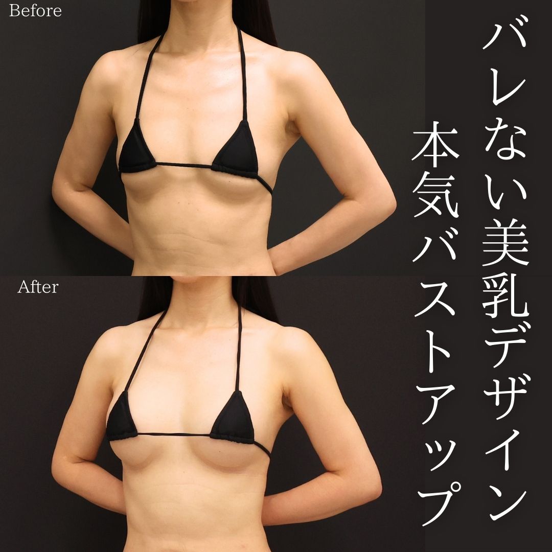 ボトックス注射：その他/シリコンバッグ豊胸（人工乳腺バッグ）の症例写真 施術前後 