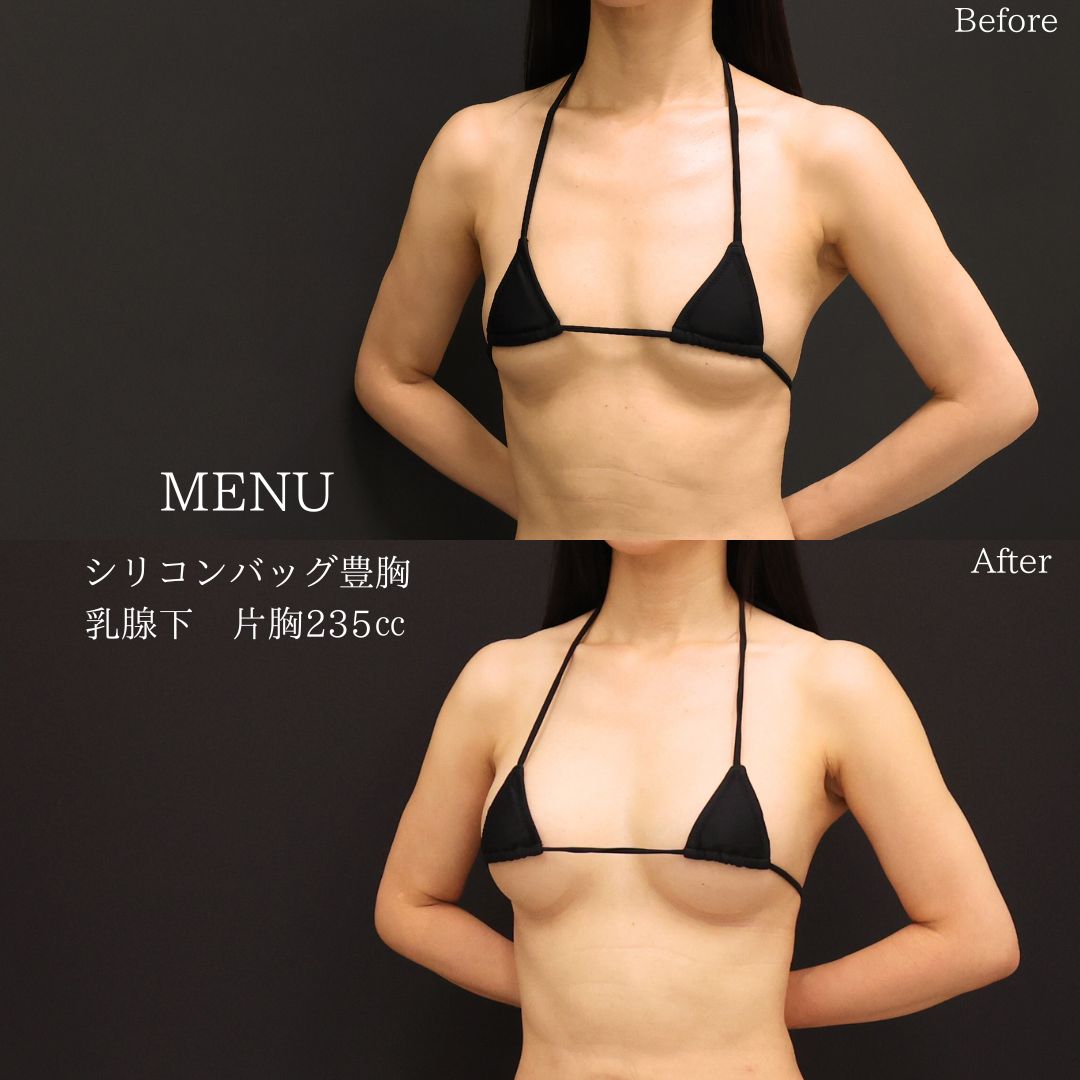 ボトックス注射：その他/シリコンバッグ豊胸（人工乳腺バッグ）の症例写真 施術前後 