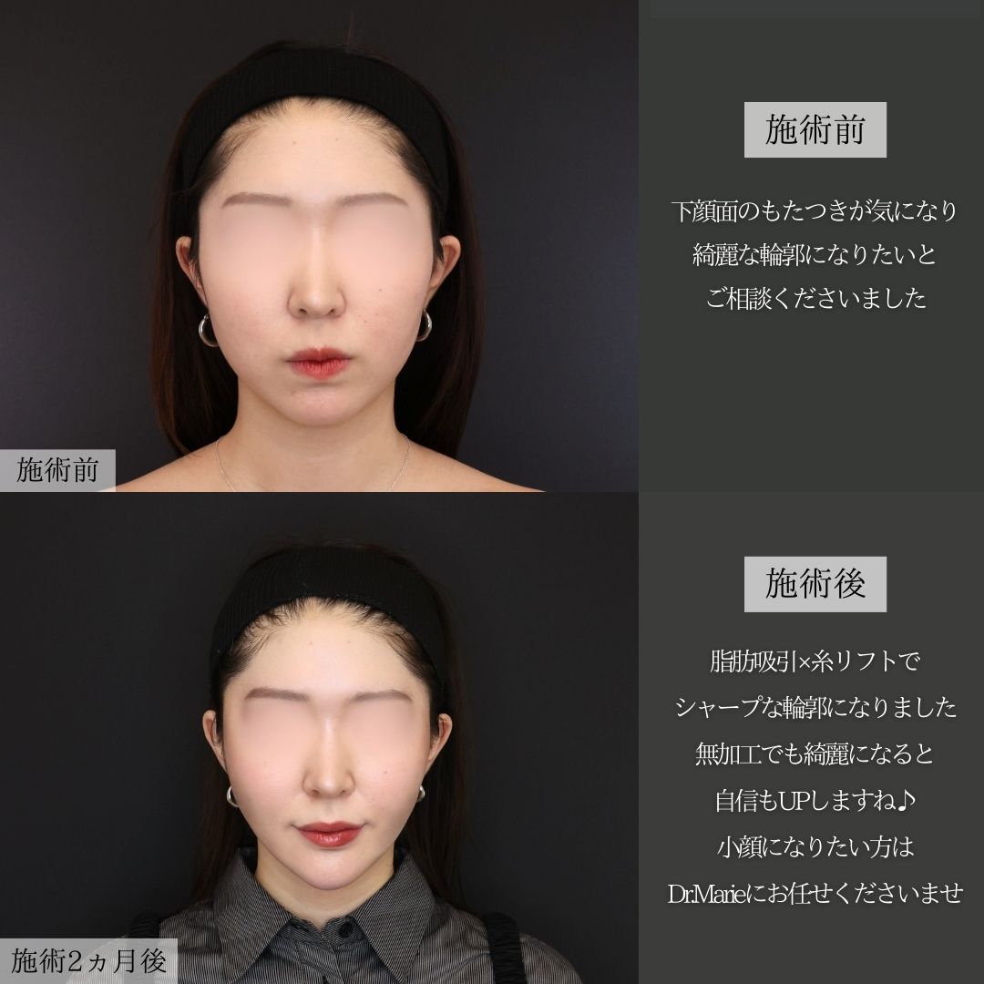 TAC式 ツヤ肌コラーゲンリフト®/Lラインファット除去（エラ下脂肪除去）/ジョールファット除去の症例写真 施術前後 