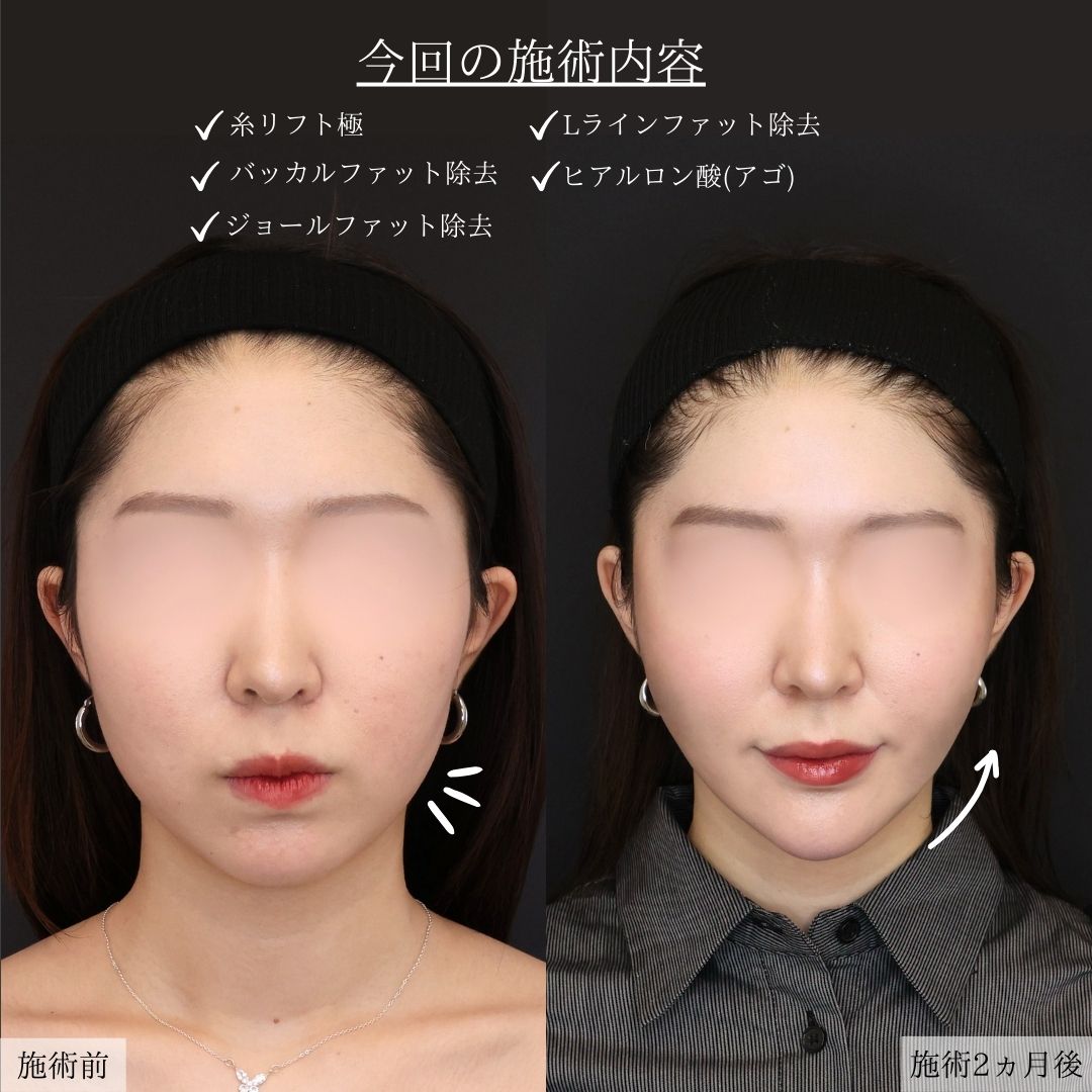 TAC式 ツヤ肌コラーゲンリフト®/Lラインファット除去（エラ下脂肪除去）/ジョールファット除去の症例写真 施術前後 