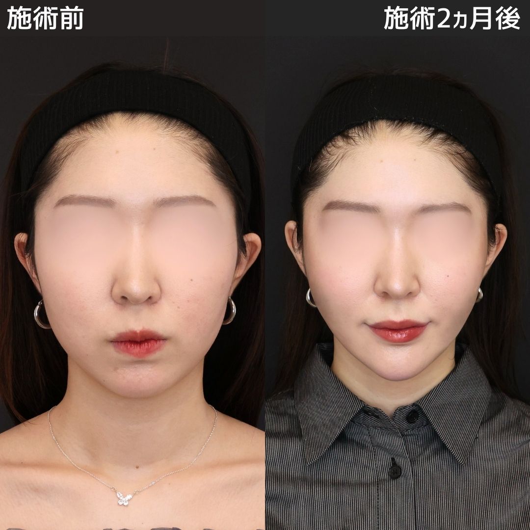 まりえ先生のオーダーメイド小顔施術の術後２ヵ月の比較写真