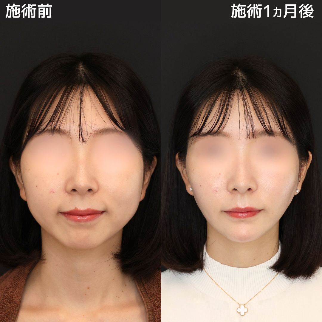 《小顔整形》美しいフェイスラインになりたいならまりえ先生！