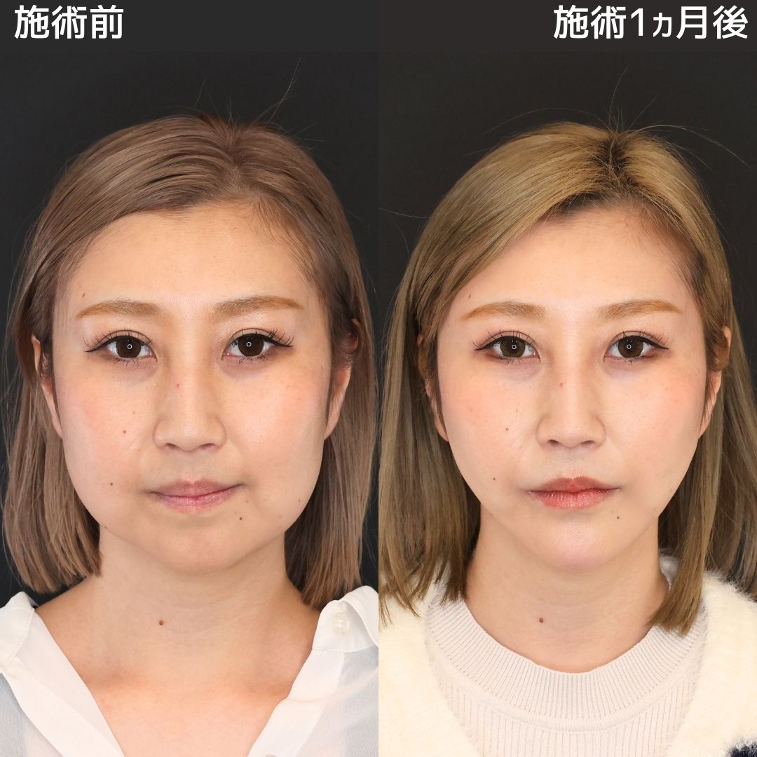 《小顔整形》-10歳若く見られるようになりました！