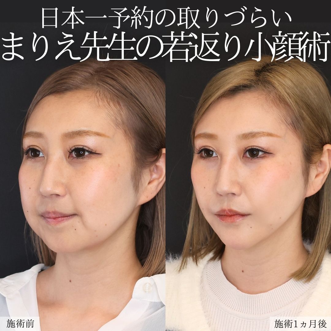 TAC式 ツヤ肌コラーゲンリフト®/ジョールファット除去/バッカルファット除去の症例写真 施術前後 