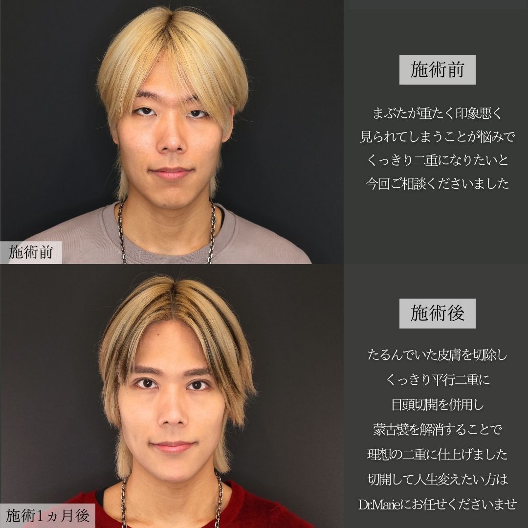 上眼瞼切開術/眼瞼下垂（目つき矯正）/目頭切開術の症例写真 施術前後 