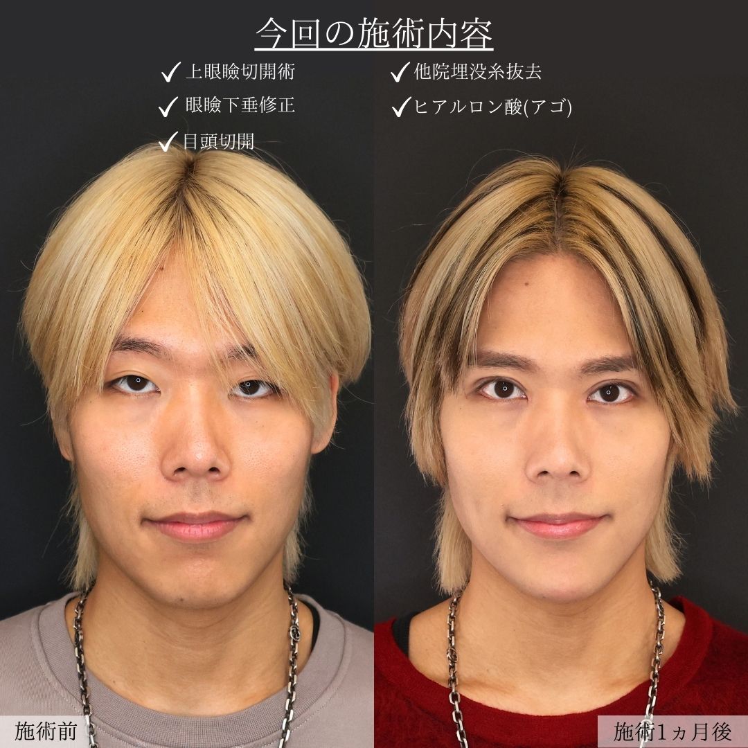 上眼瞼切開術/眼瞼下垂（目つき矯正）/目頭切開術の症例写真 施術前後 