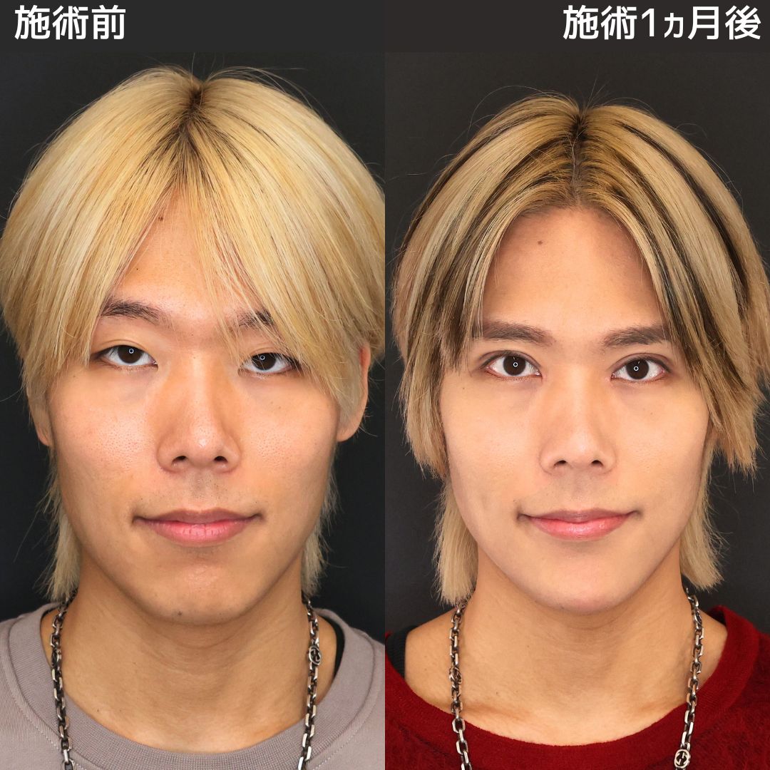 眼瞼下垂 銀座の症例写真・画像・ビフォーアフター｜美容整形