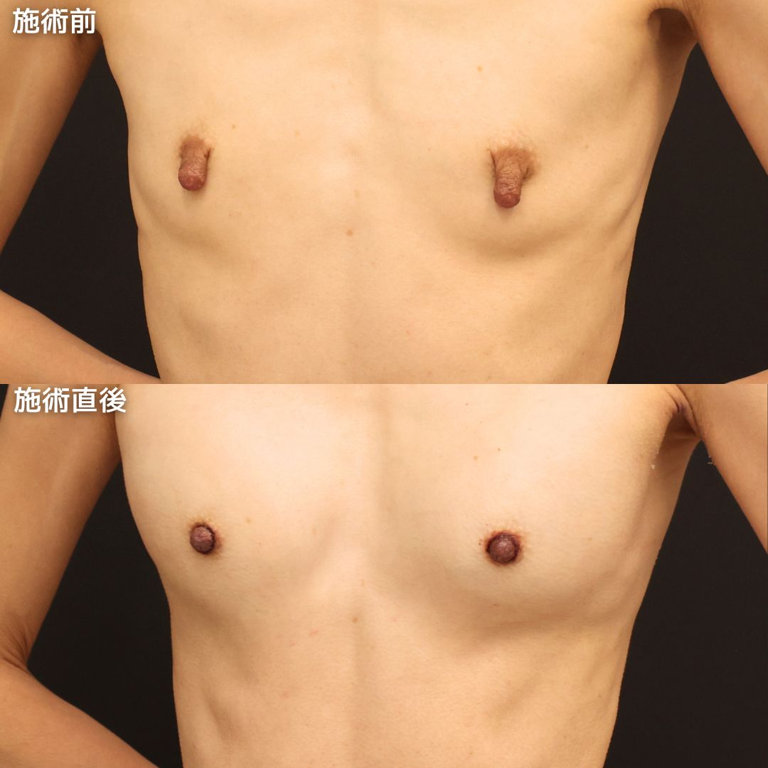 乳頭縮小術/ヒアルロン酸注入豊胸術(グラビアバスト)の症例写真 施術前後