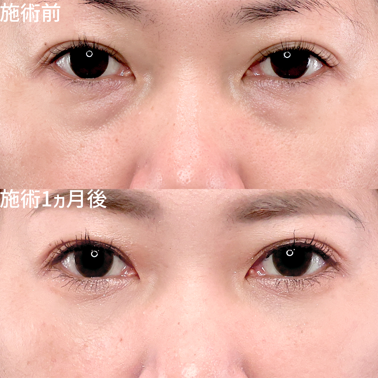 印象激変！クマ取りで明るく若々しい目元に