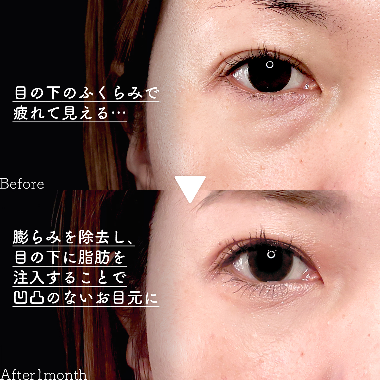 下眼瞼脱脂術（目の下のたるみ取り・目の下の脂肪ふくらみ取り）/顔の脂肪注入(コンデンスリッチフェイス)の症例写真 施術前後 