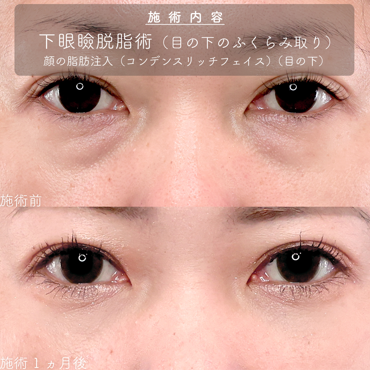 下眼瞼脱脂術（目の下のたるみ取り・目の下の脂肪ふくらみ取り）/顔の脂肪注入(コンデンスリッチフェイス)の症例写真 施術前後 