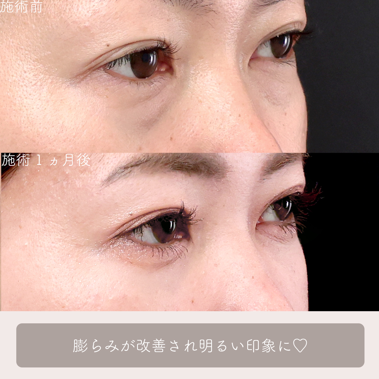 下眼瞼脱脂術（目の下のたるみ取り・目の下の脂肪ふくらみ取り）/顔の脂肪注入(コンデンスリッチフェイス)の症例写真 施術前後 